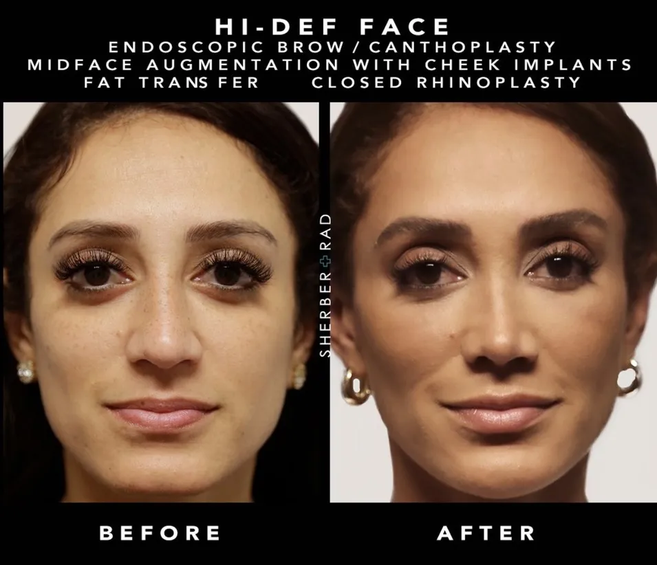 Facial Implants before and after photos by Sherber and Rad in Washington DC