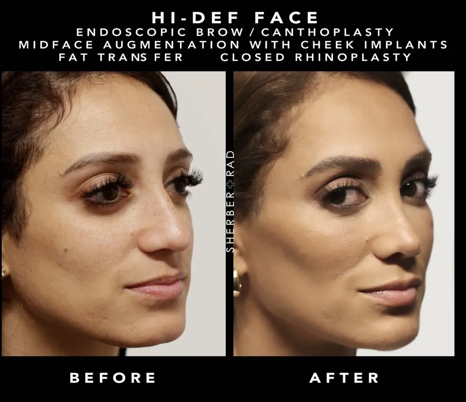 Facial Implants before and after photos by Sherber and Rad in Washington DC