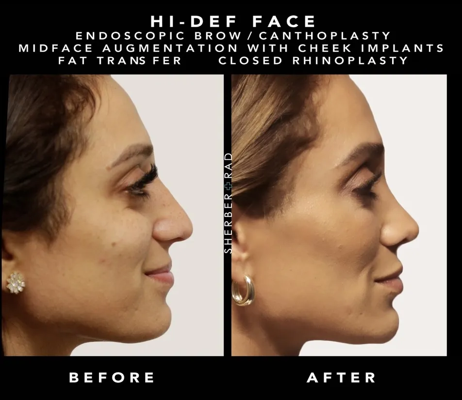 Facial Implants before and after photos by Sherber and Rad in Washington DC