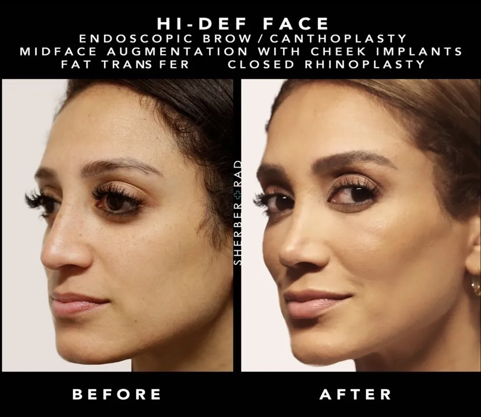 Facial Implants before and after photos by Sherber and Rad in Washington DC