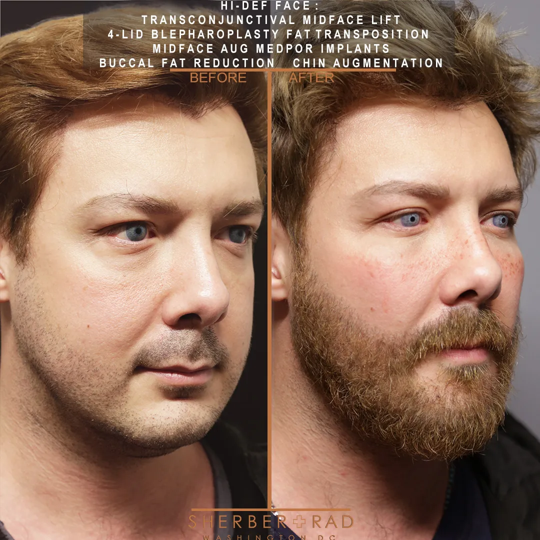 Facial Implants before and after photos by Sherber and Rad in Washington DC