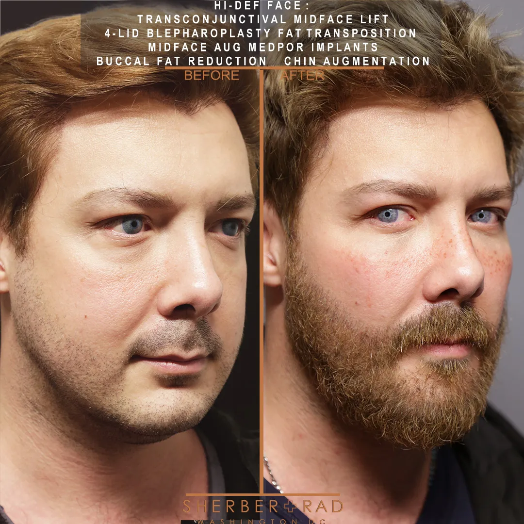 Facial Implants before and after photos by Sherber and Rad in Washington DC
