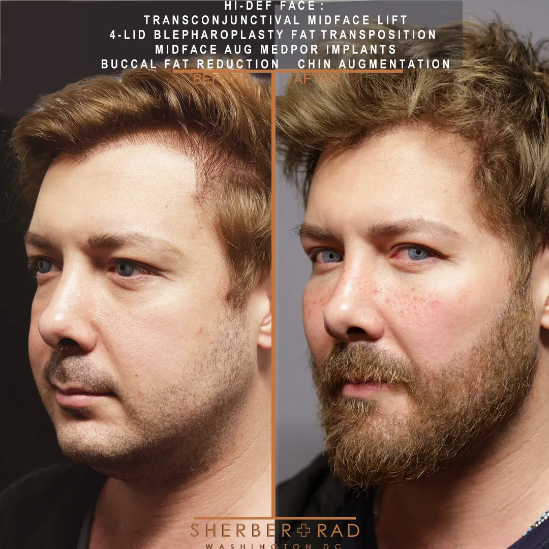 Facial Implants before and after photos by Sherber and Rad in Washington DC