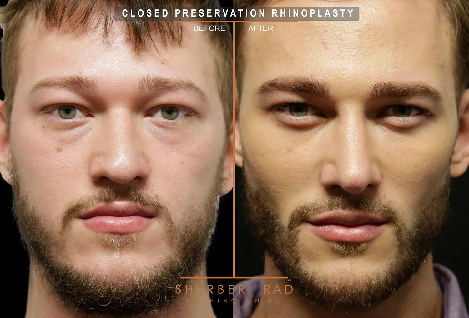 Facial Implants before and after photos by Sherber and Rad in Washington DC