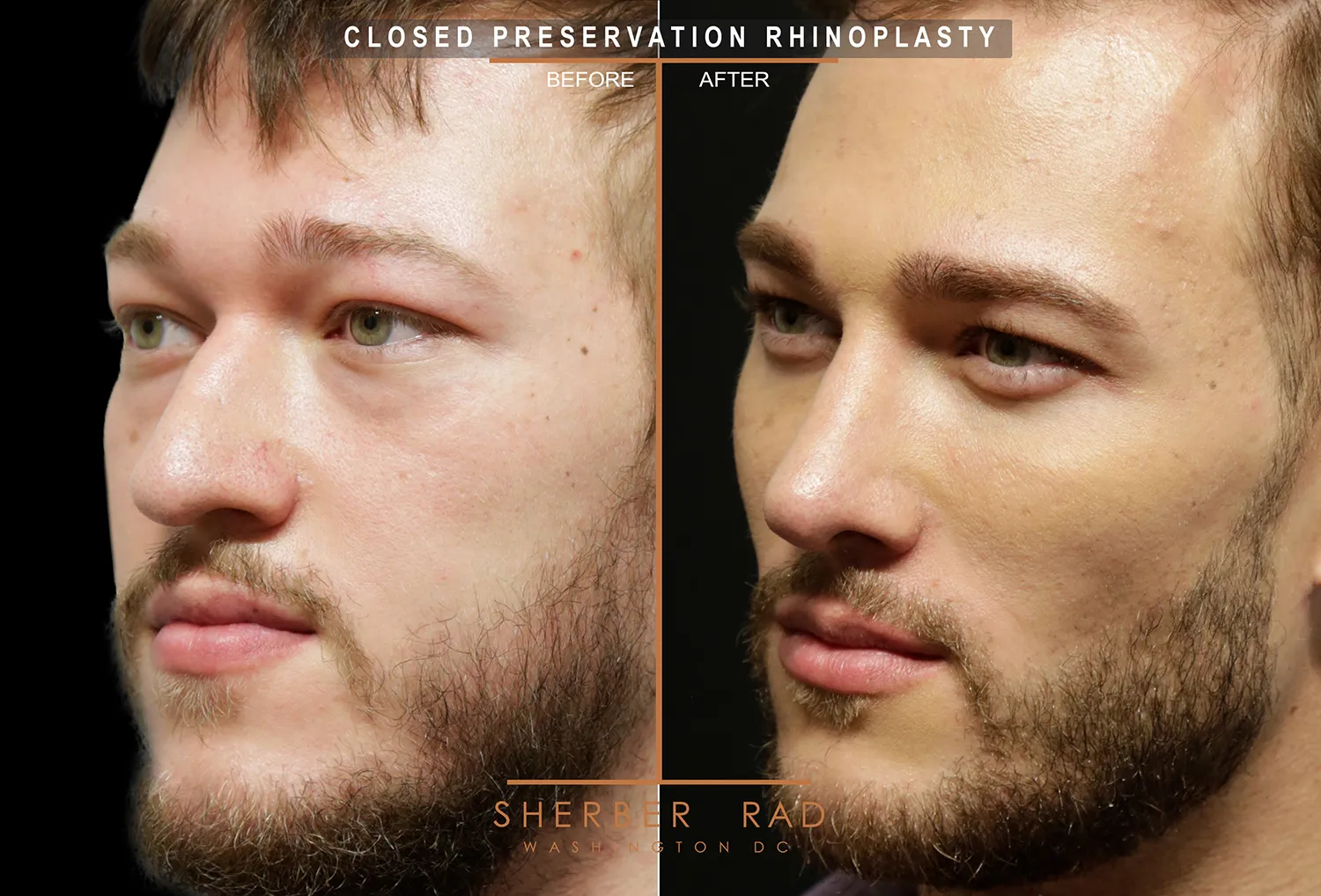 Facial Implants before and after photos by Sherber and Rad in Washington DC