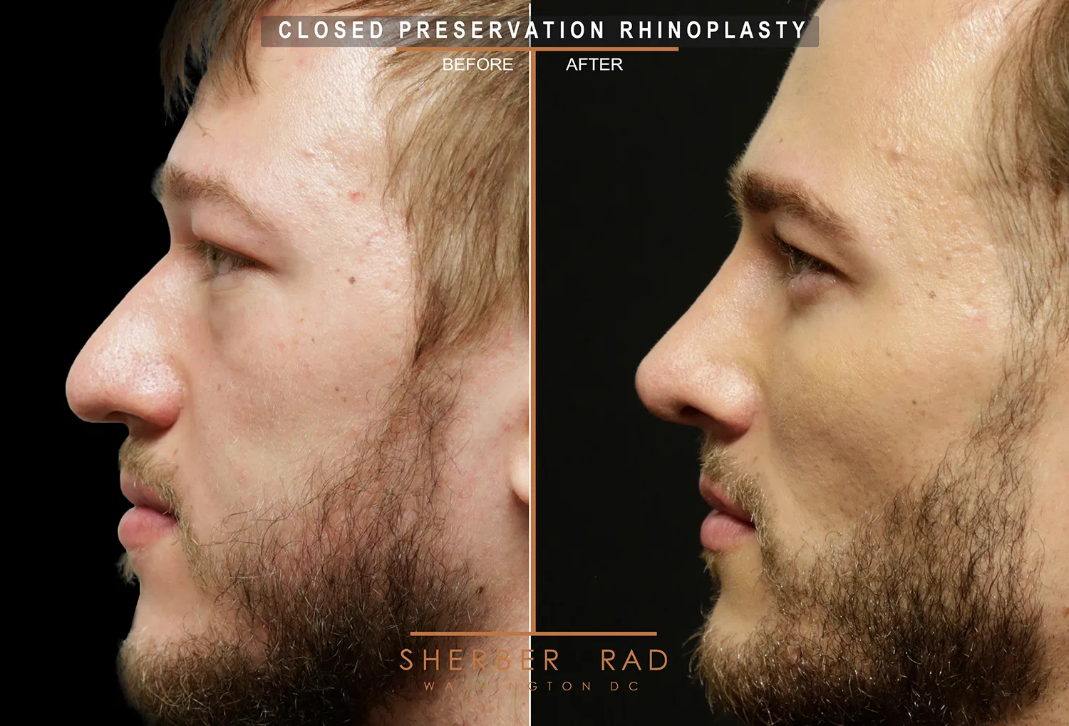 Facial Implants before and after photos by Sherber and Rad in Washington DC