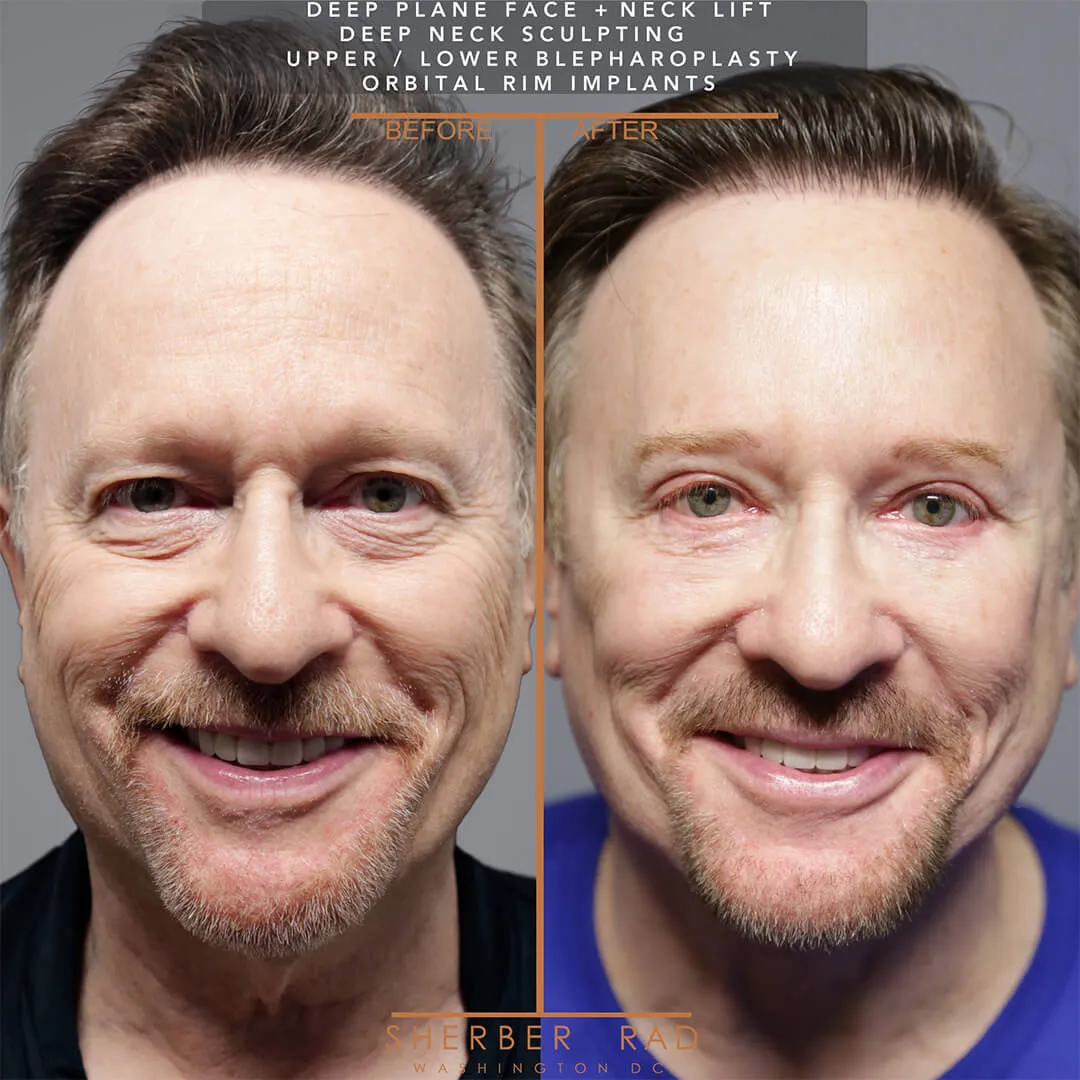 Male Facelift before and after photos by Sherber and Rad in Washington DC