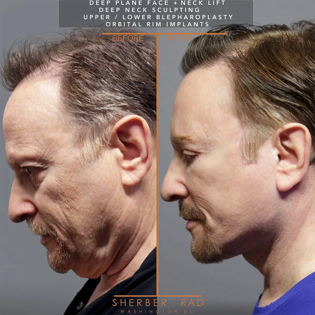 Male Facelift before and after photos by Sherber and Rad in Washington DC