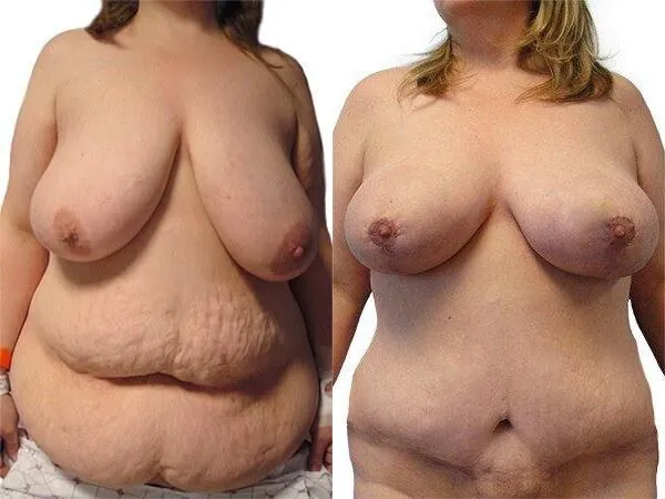 Breast Lift + Reduction before and after photos by Sherber and Rad in Washington, DC