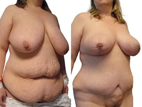 Breast Lift + Reduction before and after photos by Sherber and Rad in Washington, DC