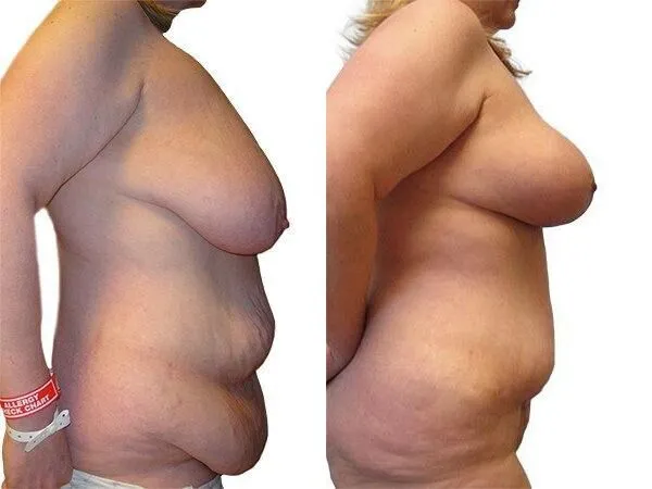 Breast Lift + Reduction before and after photos by Sherber and Rad in Washington, DC