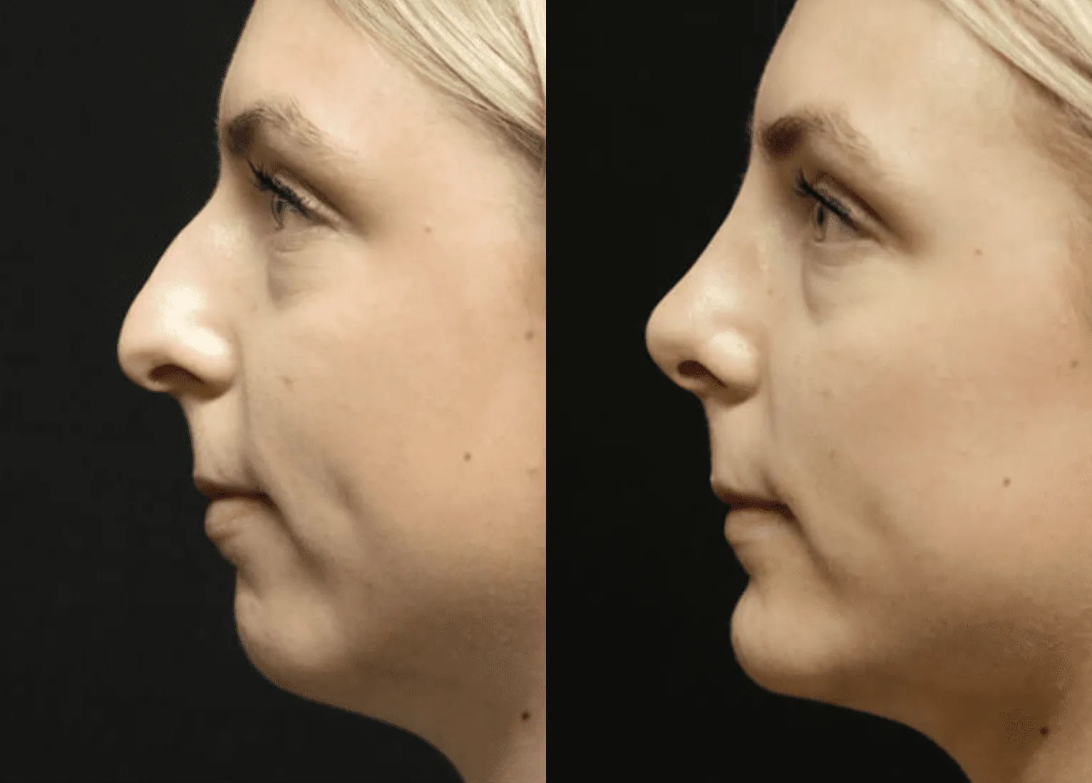 Chin + Jaw Reshaping before and after photos by Sherber and Rad in Washington, DC