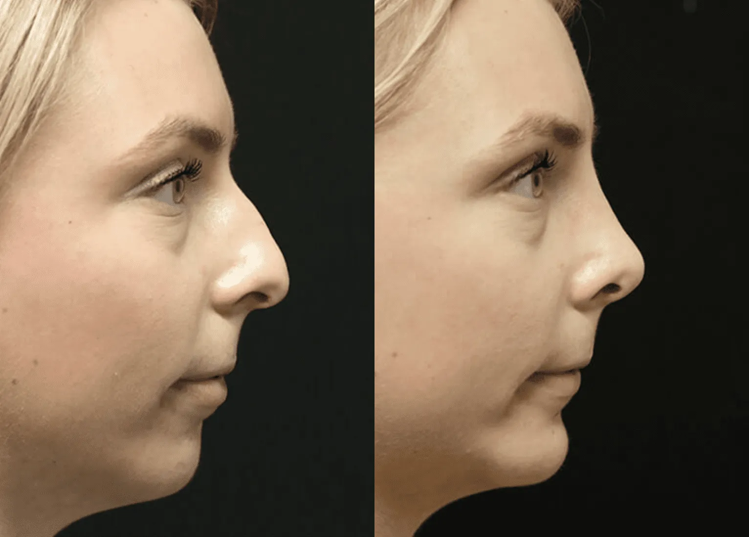 Chin + Jaw Reshaping before and after photos by Sherber and Rad in Washington, DC