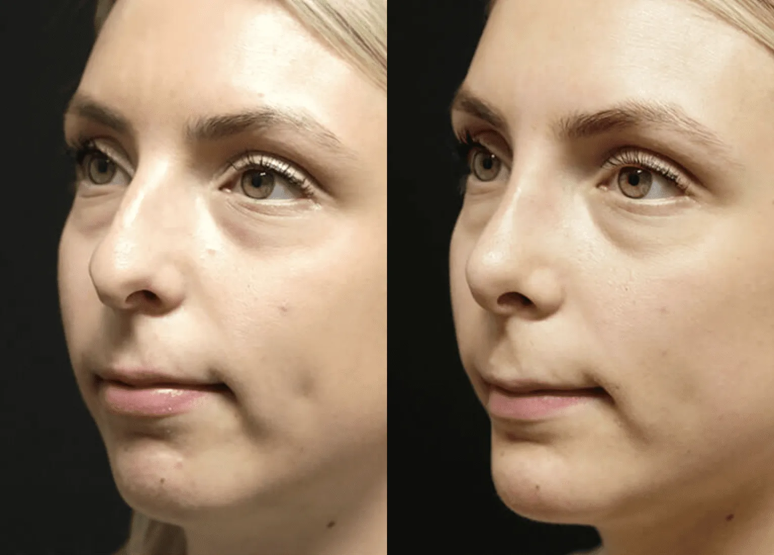 Chin + Jaw Reshaping before and after photos by Sherber and Rad in Washington, DC