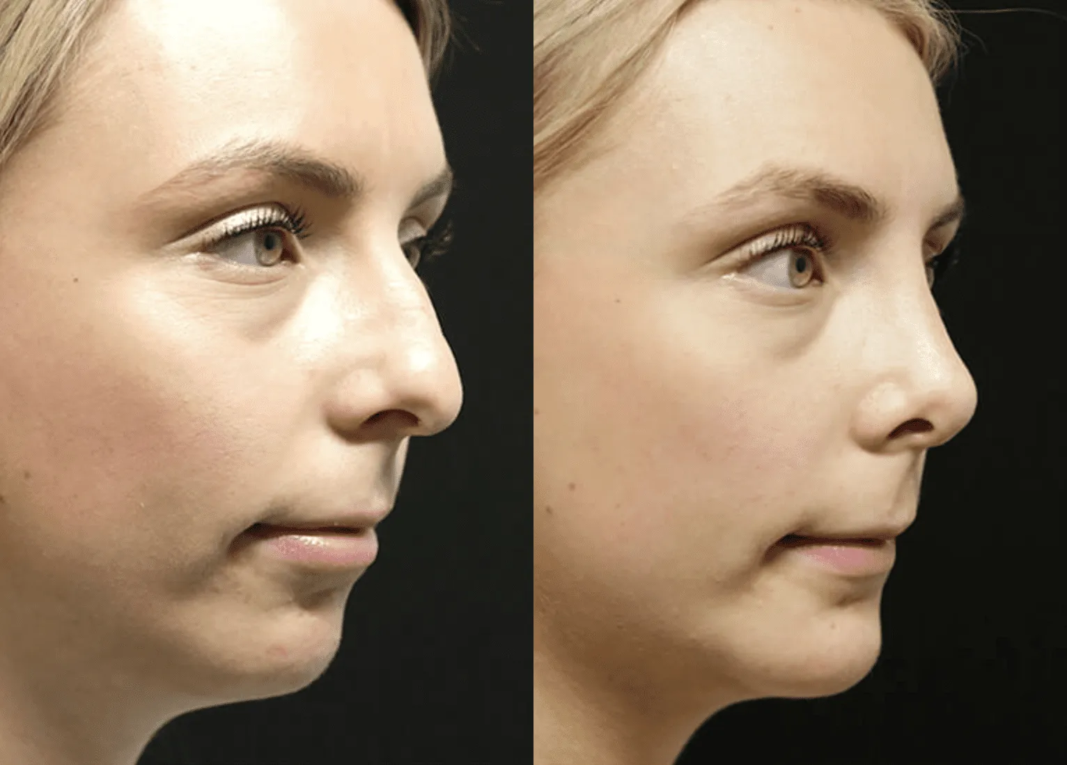 Chin + Jaw Reshaping before and after photos by Sherber and Rad in Washington, DC