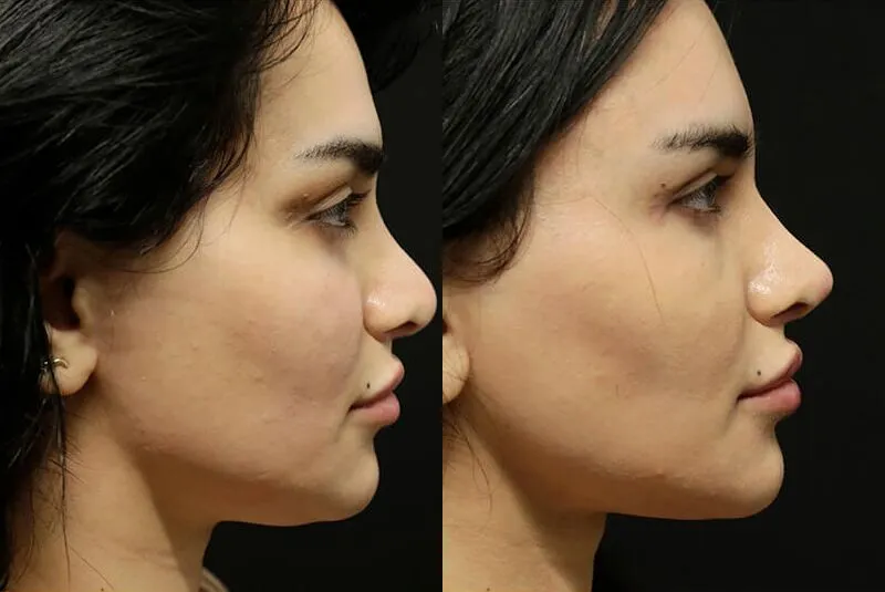 Facial Fat Transfer before and after photos by Sherber and Rad in Washington, DC