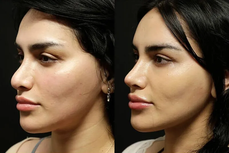 Facial Fat Transfer before and after photos by Sherber and Rad in Washington, DC