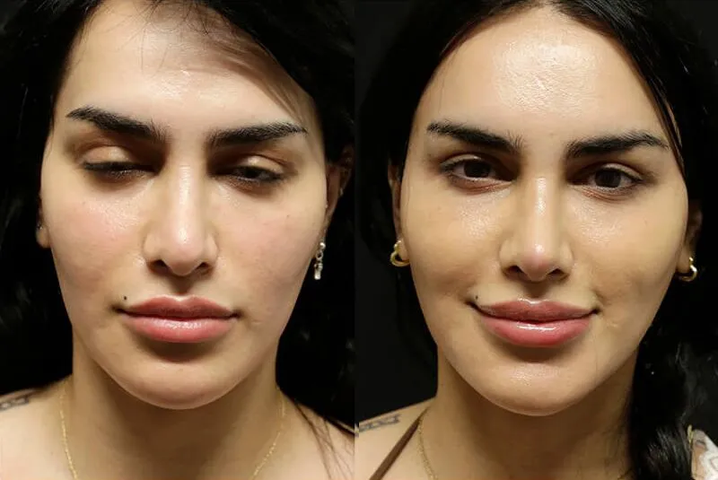 Facial Fat Transfer before and after photos by Sherber and Rad in Washington, DC