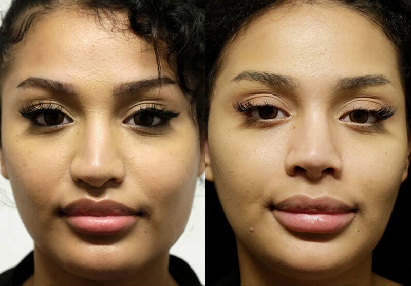 Chin + Jaw Reshaping before and after photos by Sherber and Rad in Washington, DC