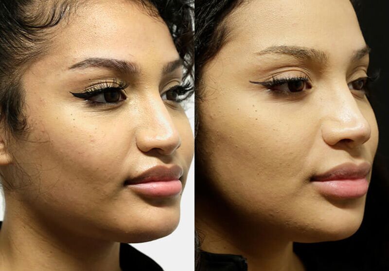 Chin + Jaw Reshaping before and after photos by Sherber and Rad in Washington, DC