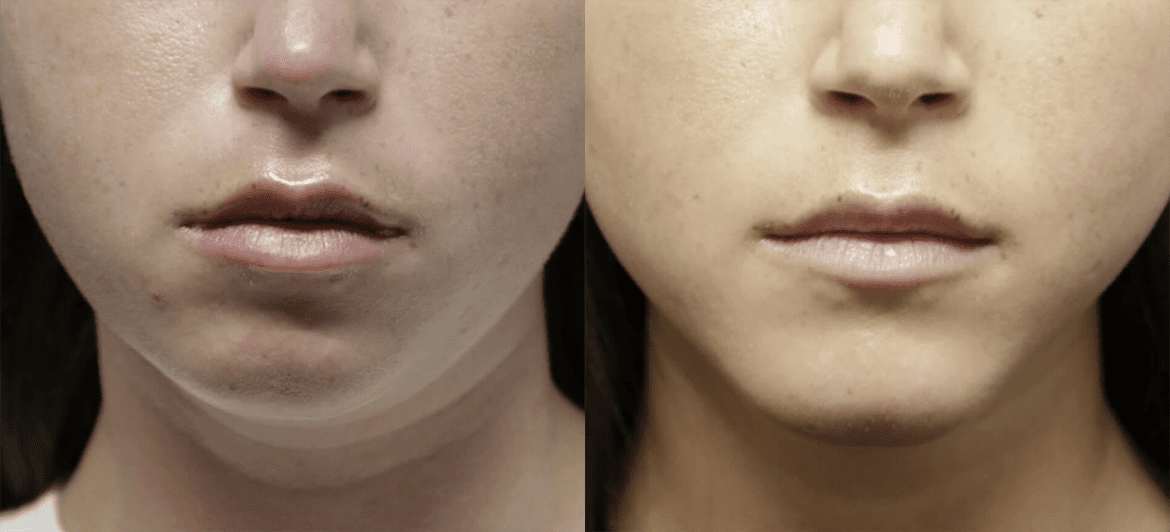 Chin + Jaw Reshaping before and after photos by Sherber and Rad in Washington, DC