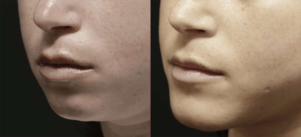 Chin + Jaw Reshaping before and after photos by Sherber and Rad in Washington, DC