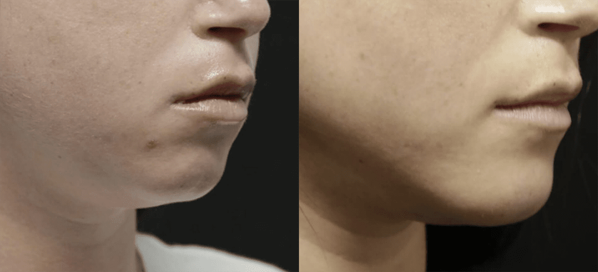 Chin + Jaw Reshaping before and after photos by Sherber and Rad in Washington, DC