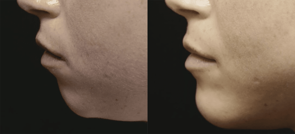 Chin + Jaw Reshaping before and after photos by Sherber and Rad in Washington, DC