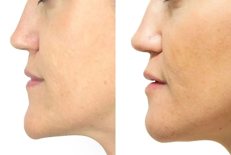 Chin + Jaw Reshaping before and after photos by Sherber and Rad in Washington, DC