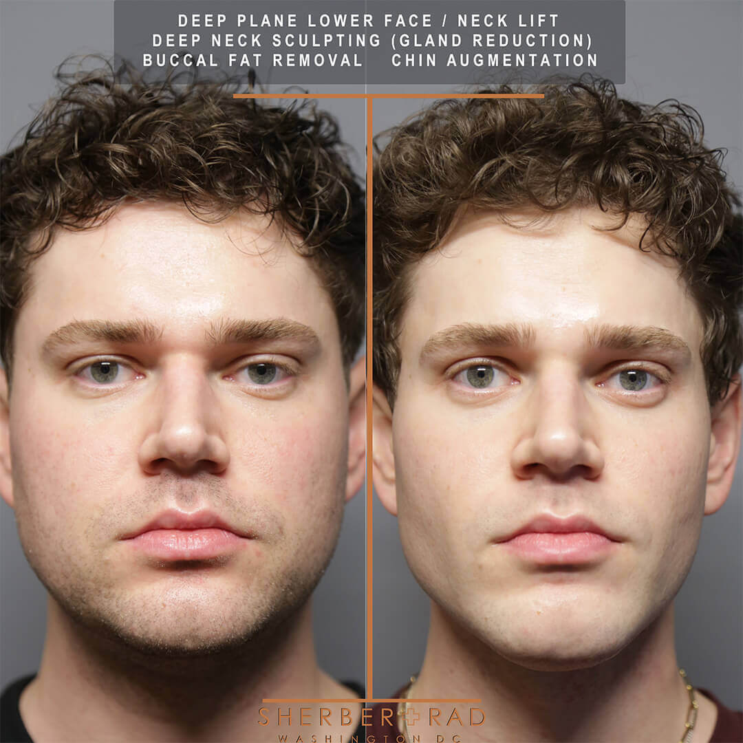 male facelift before and after photos by sherber and rad in washington dc