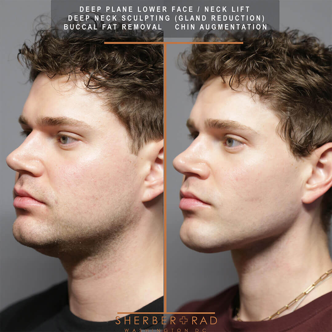male facelift before and after photos by sherber and rad in washington dc