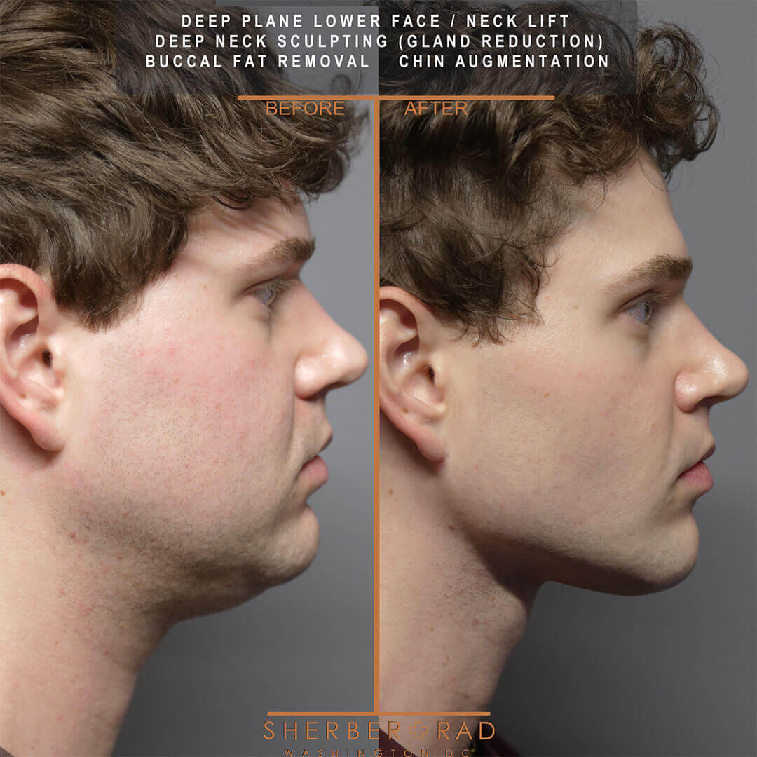 male facelift before and after photos by sherber and rad in washington dc