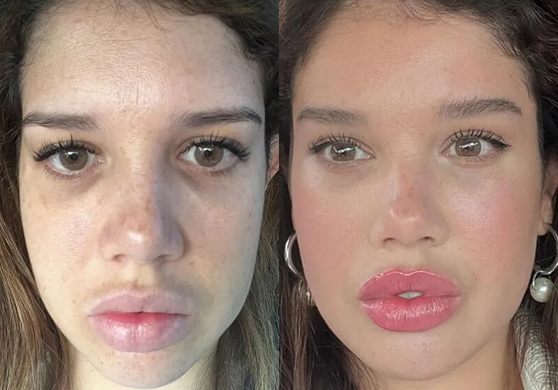Female Eyelid Lift before and after photos by Sherber and Rad in Washington, DC