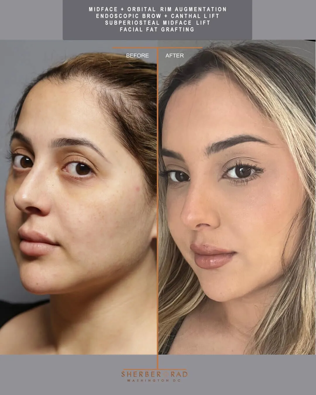 endoscopic brow lift before and after photos by sherber and rad in washington dc