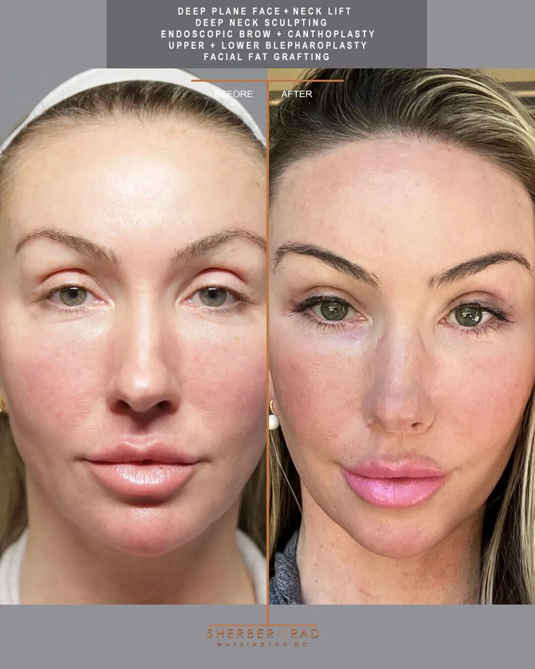 deep plane facelift before and after photos by sherber and rad in washington dc