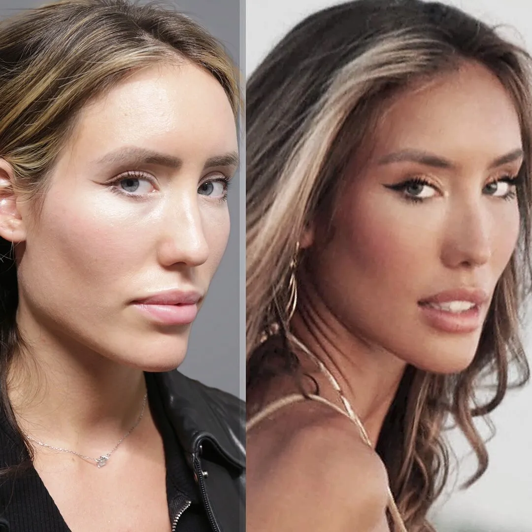 Jaw Reduction before and after photos by Sherber and Rad in Washington DC