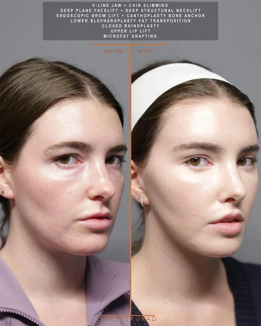 Jaw Reduction before and after photos by Sherber and Rad in Washington DC