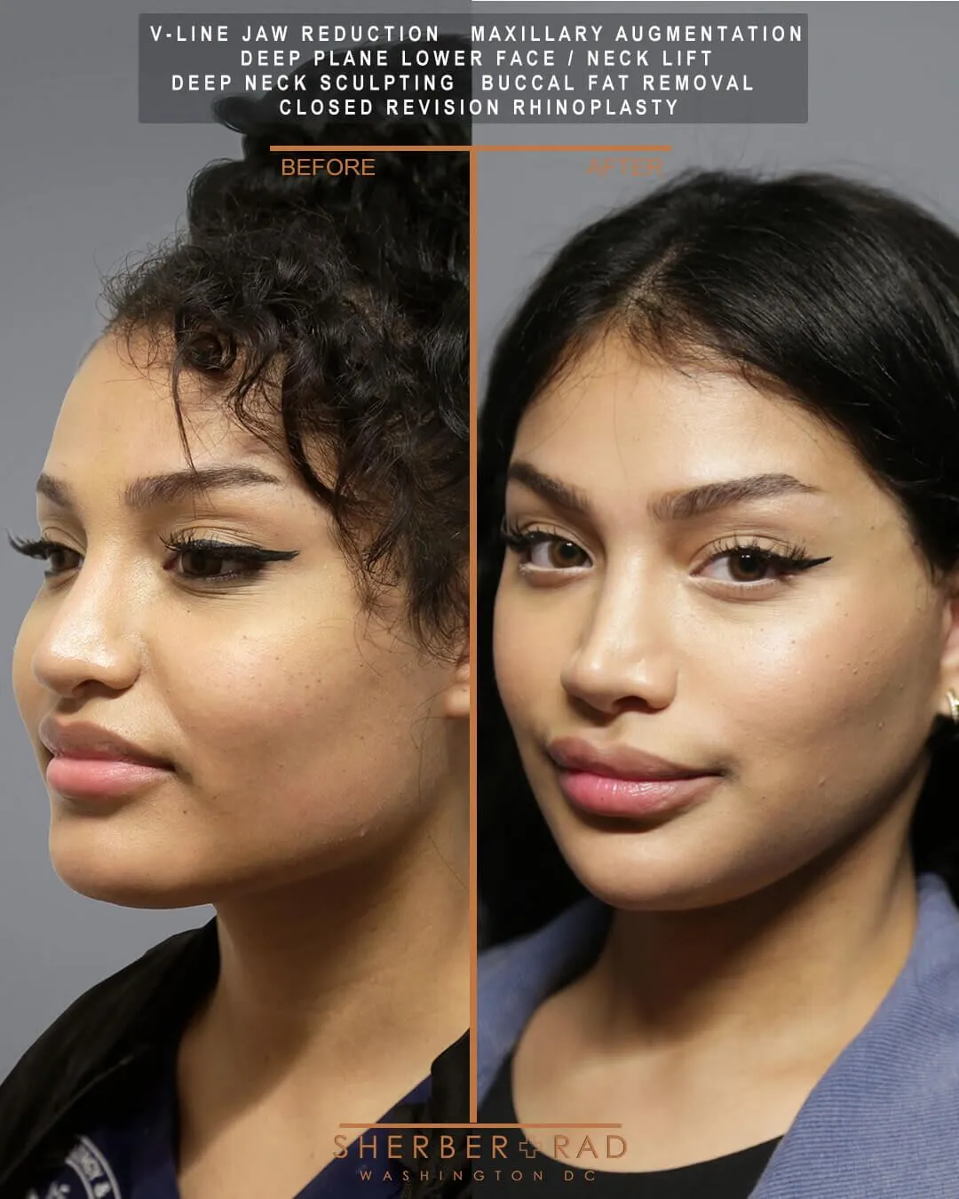 Jaw Reduction before and after photos by Sherber and Rad in Washington DC