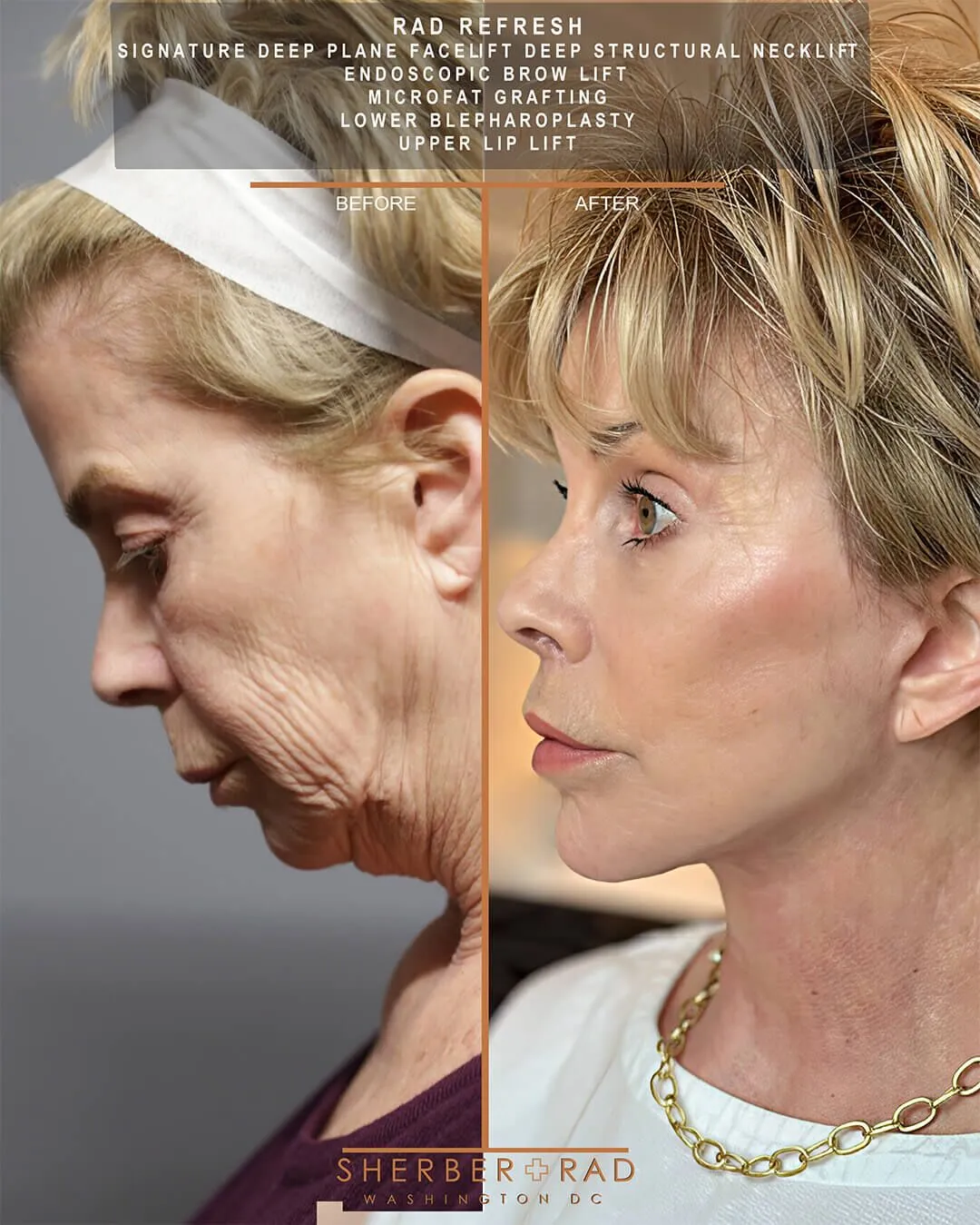 Deep Plane Facelift before and after photos by Sherber and Rad in Washington DC