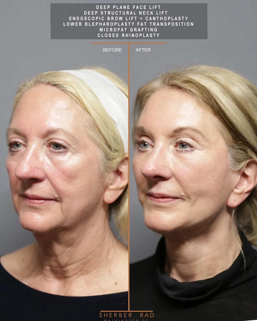 left oblique view facelift browlift blepharoplasty fat grafting before and after photos by sherber and rad