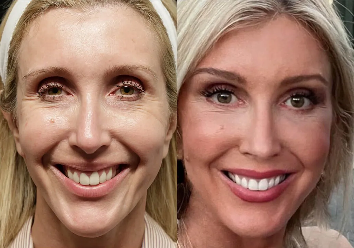 Facelift before and after photos by Sherber and Rad in Washington, DC