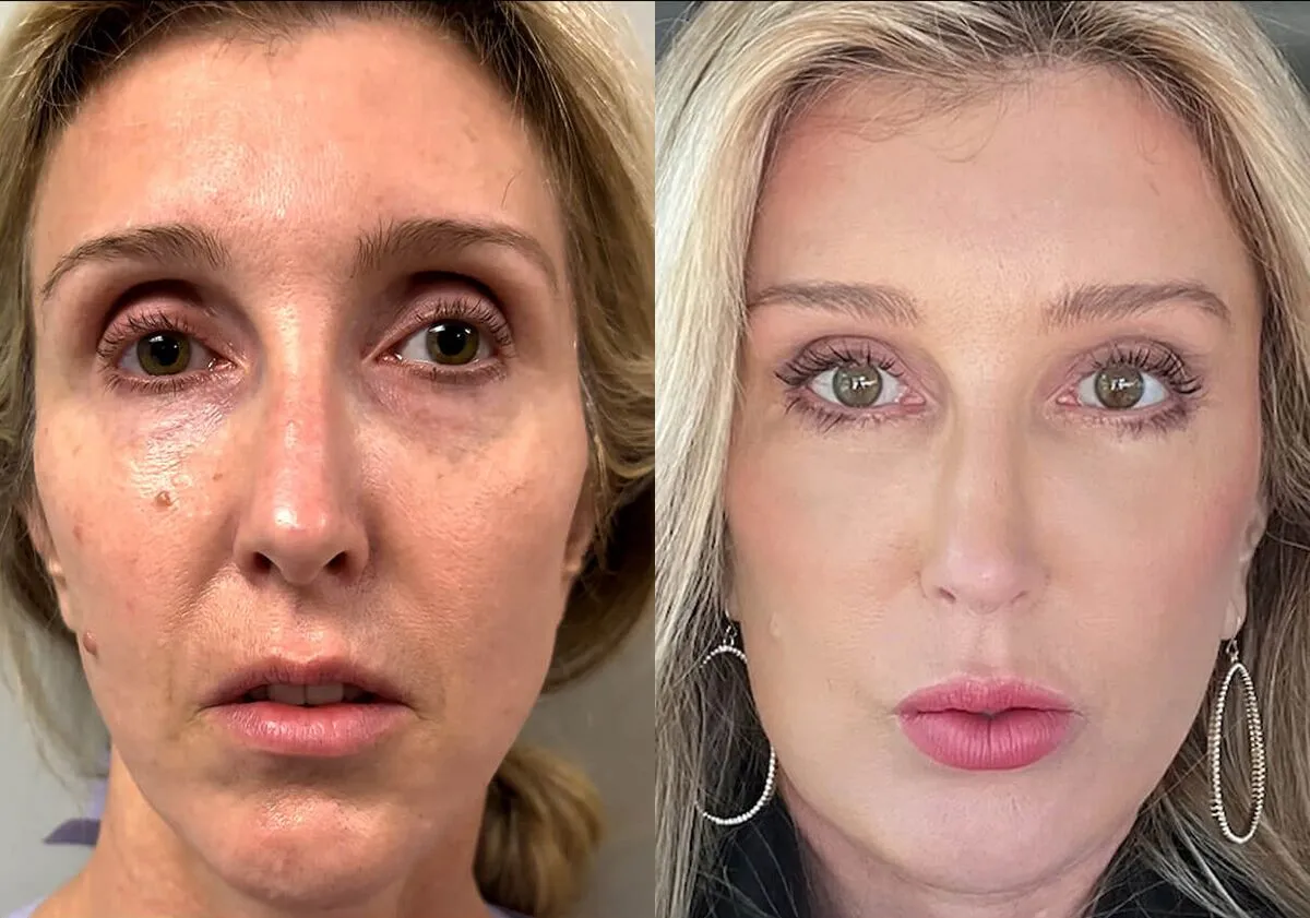 Facelift before and after photos by Sherber and Rad in Washington, DC
