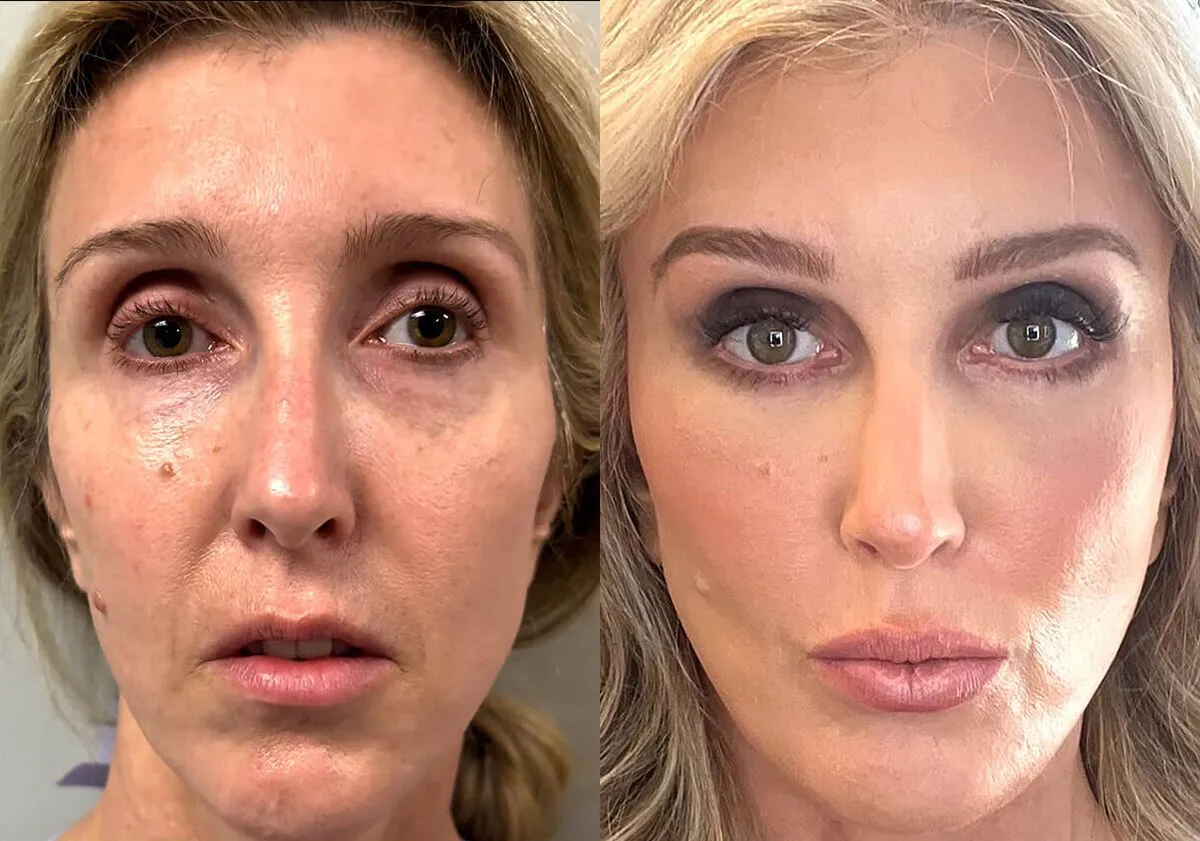 Facelift before and after photos by Sherber and Rad in Washington, DC