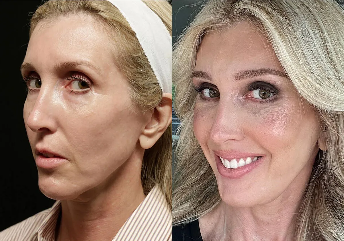 Facelift before and after photos by Sherber and Rad in Washington, DC