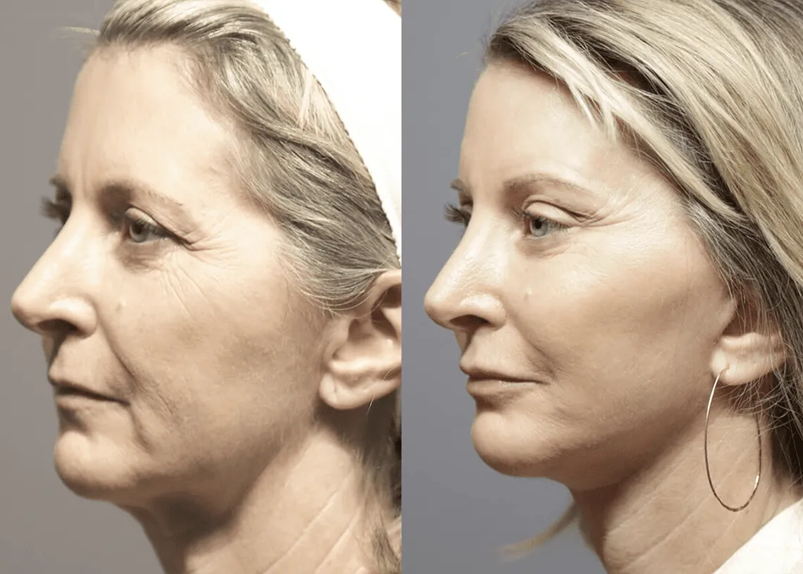 Facelift before and after photos by Sherber and Rad in Washington, DC