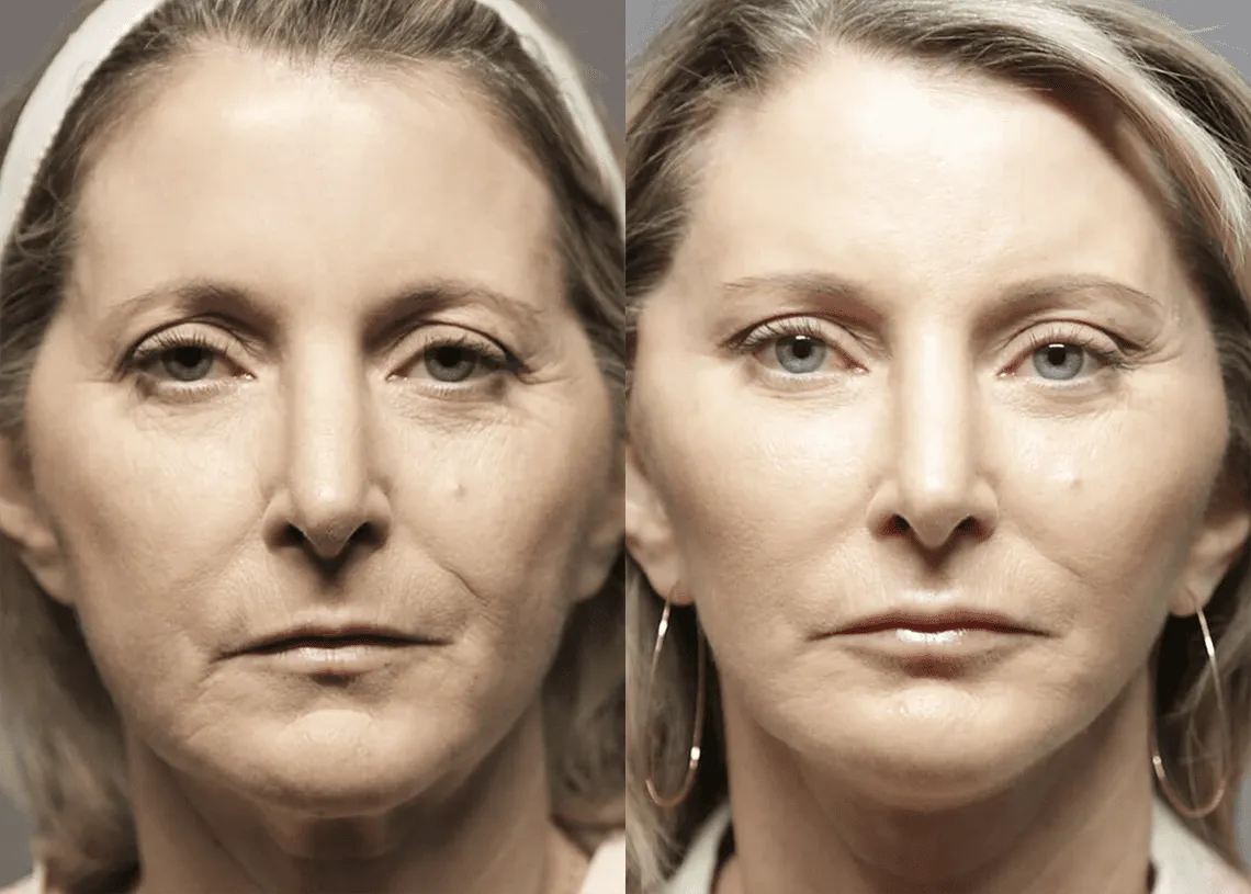 Facelift before and after photos by Sherber and Rad in Washington, DC