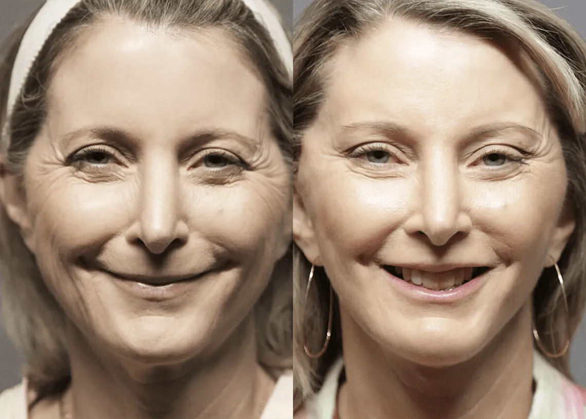 Facelift before and after photos by Sherber and Rad in Washington, DC