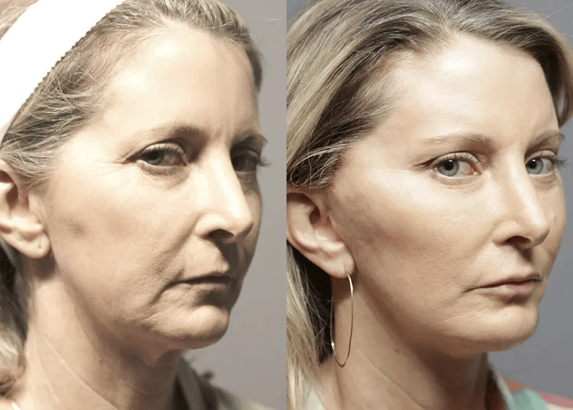 Facelift before and after photos by Sherber and Rad in Washington, DC