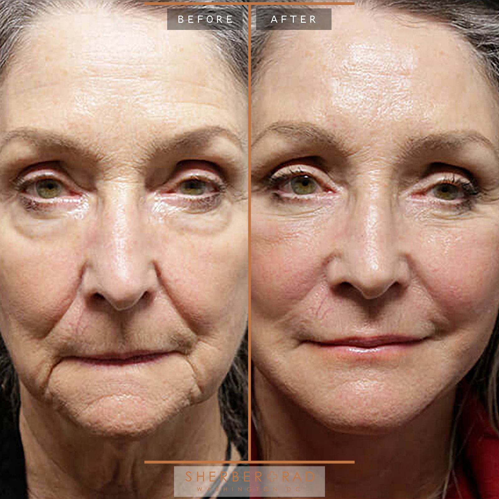 Facelift before and after photos by Sherber and Rad in Washington, DC