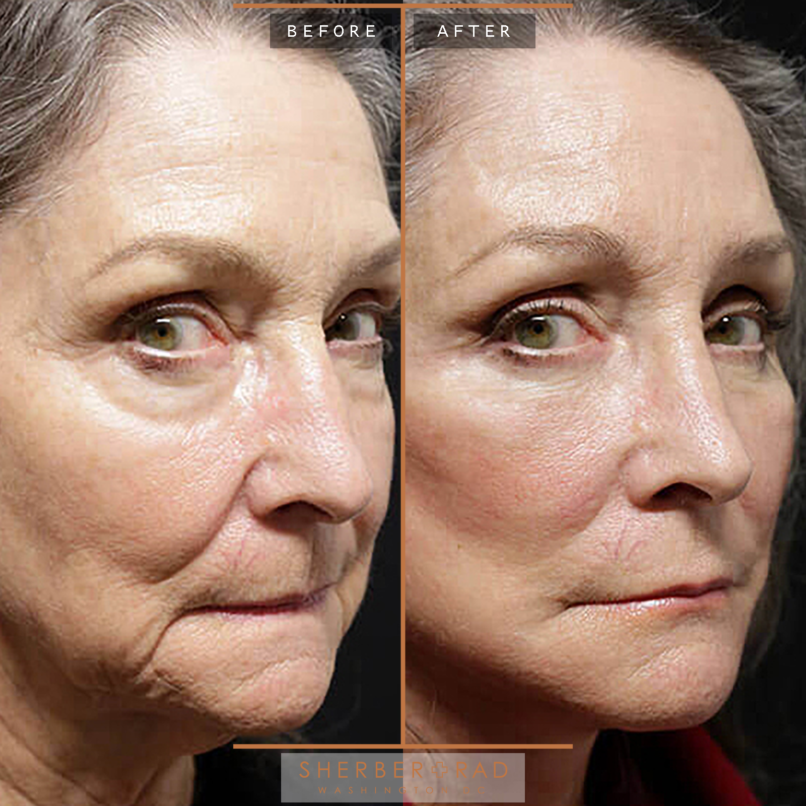 Facelift before and after photos by Sherber and Rad in Washington, DC
